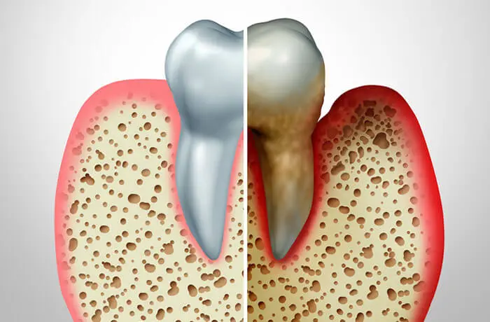Ozone Therapy for Periodontal Disease Treatment Dental Ozone Treatment Orange County, CA